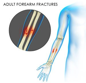 Adult Forearm Fractures