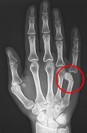 Boxer's Fracture Treatment Sandton | Hand Fracture Midrand, South Africa