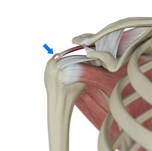 Calcification Tendinitis