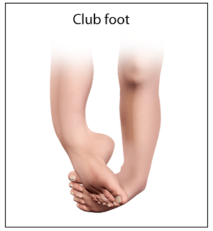 Congenital Deformity and Clubfoot