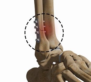 Complex Foot & Ankle Surgeries