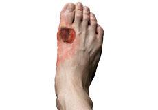 Diabetic Foot