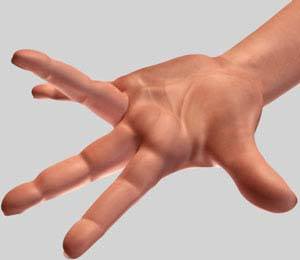 Dupuytren's Contracture