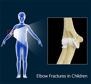 Elbow Fractures in Children