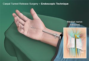 Endoscopic Carpal Tunnel Surgery