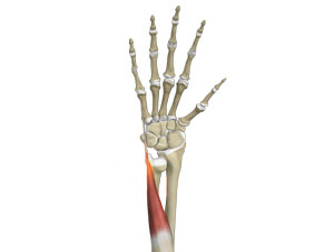 Extensor Carpi Ulnaris (ECU) Tendon Instability