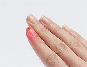 Fingertip Injuries