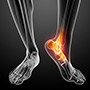 Non-Surgical Treatment for Foot & Ankle Pain