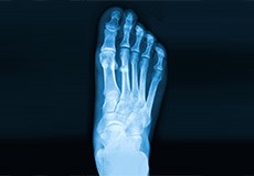 Foot Fracture