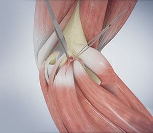 Elbow Impingement