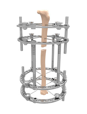 Limb Reconstruction