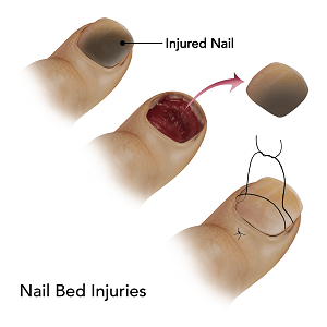 What To Do When You Injure Your Toenail  Sole Podiatry
