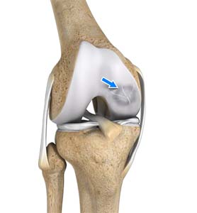 osteochondritis dissecans)