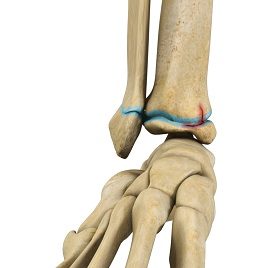 Pediatric Fractures