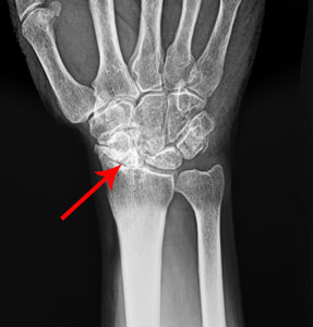 Scapholunate Advanced Collapse (SLAC) of the Wrist