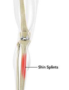 Shin Splints