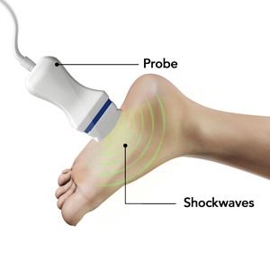 Shockwave Treatment for Plantar Fasciitis