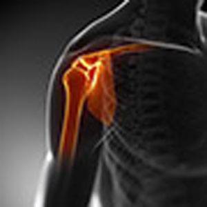 Viscosupplementation for Shoulder Arthritis