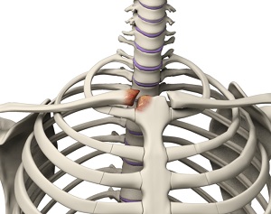 Sternoclavicular Arthritis