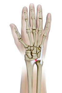 Triangular Fibrocartilage Complex (TFCC) Injury