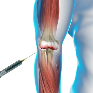 Viscosupplementation for Elbow Arthritis